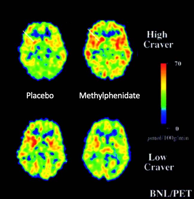 Image of Brains scans of a cocaine abuser and a non-user when methylphenidate and a placebo drug was administered. Metabolic activity is shown in the  orbitofrontal cortex. *from Cerebral Cortex 